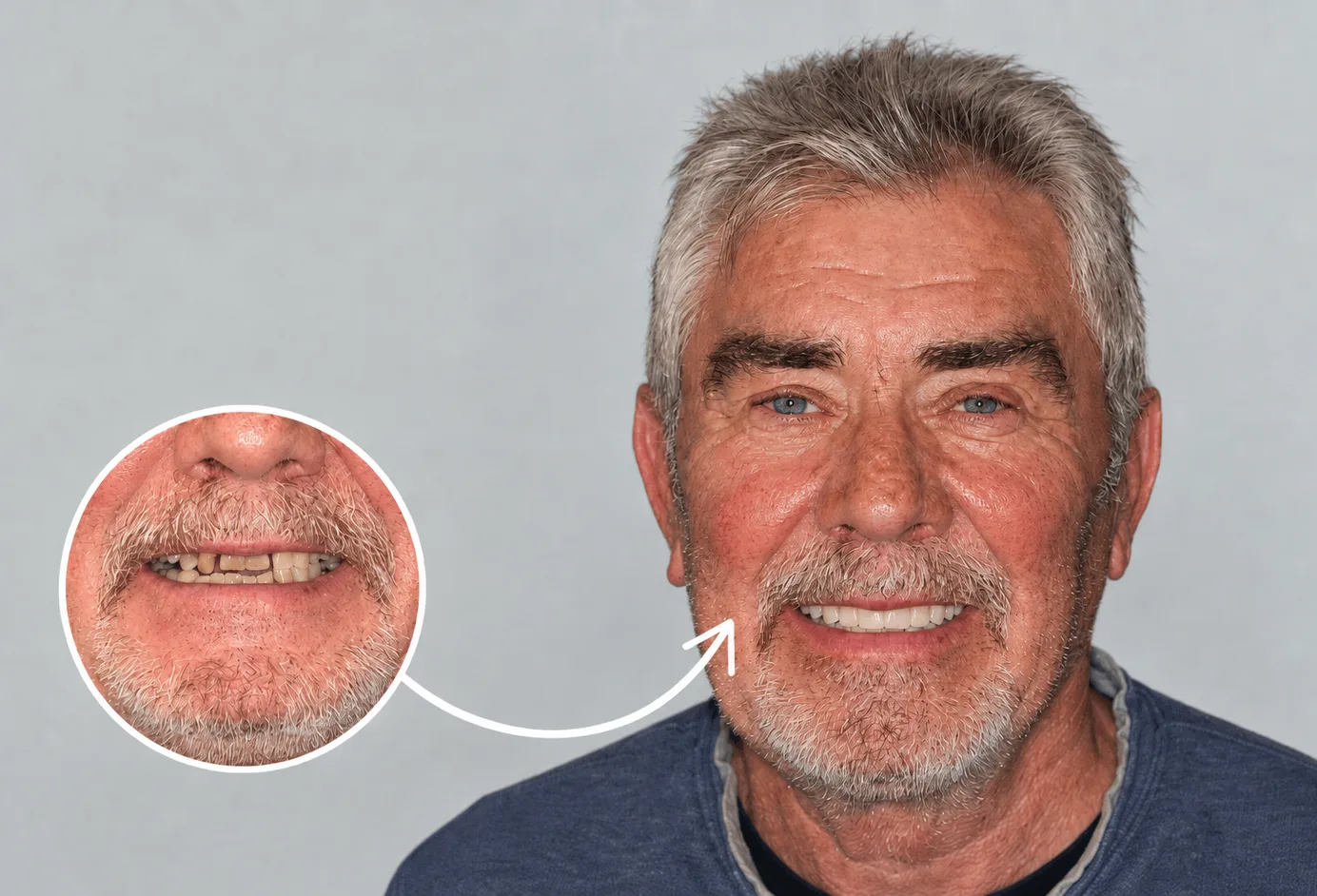 A man smiling after treatment, beside an inset close-up of his smile before it