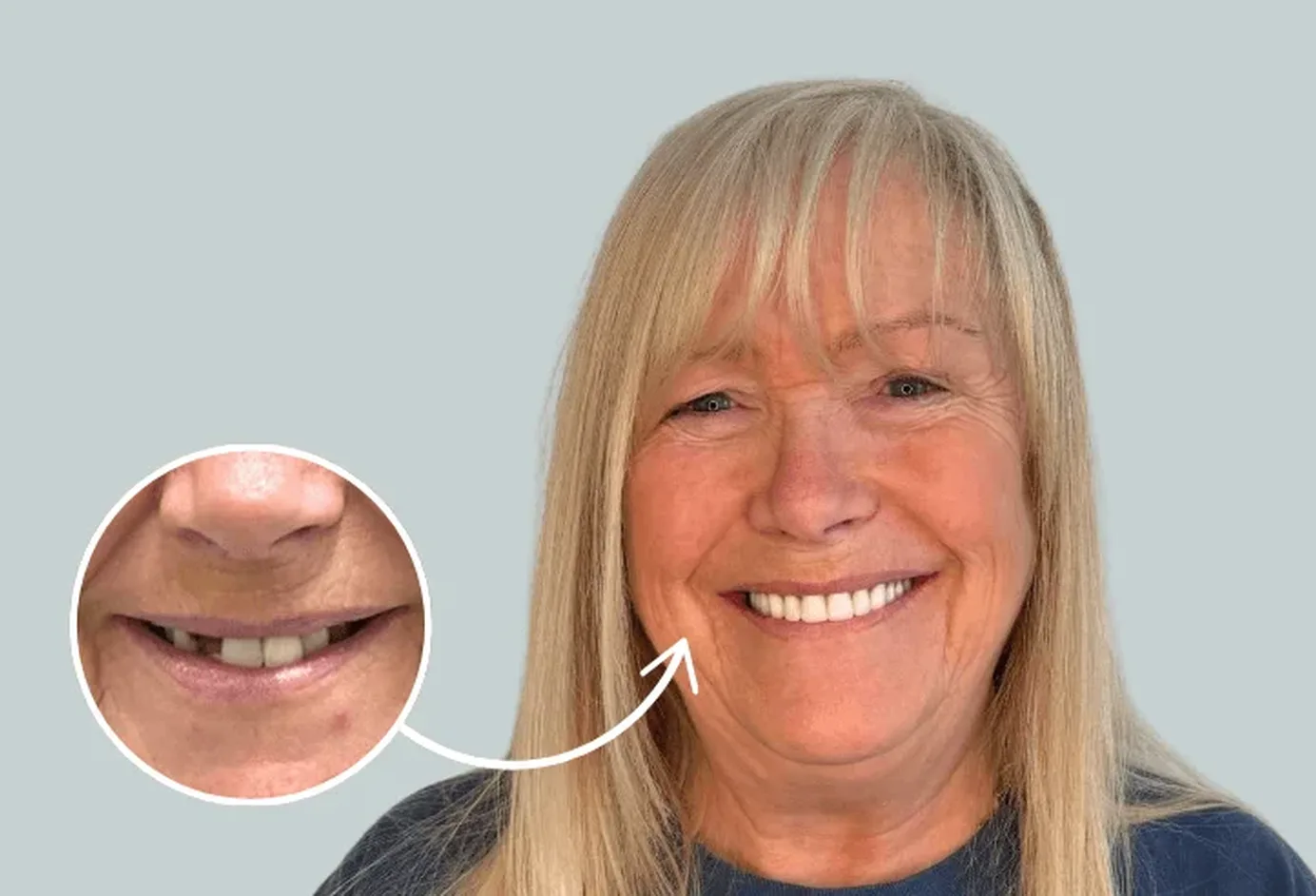 A woman smiling after treatment, beside an inset close-up of her smile before it