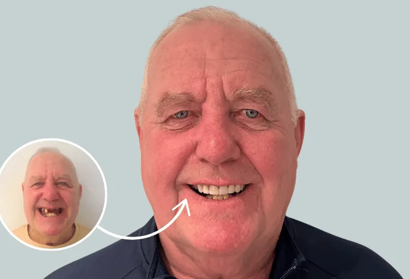 A man smiling after treatment, beside an inset photograph of his smile before it